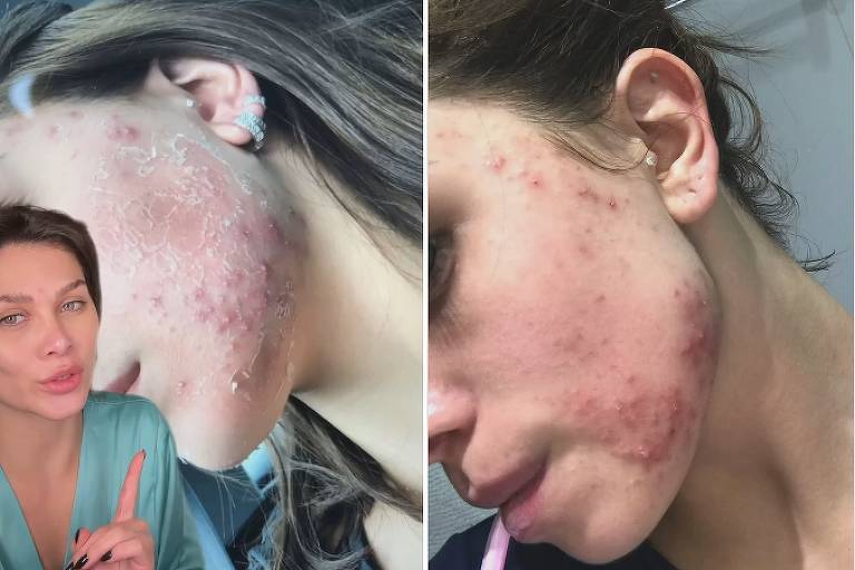 Flavia Pavanelli expõe problemas com acnes
