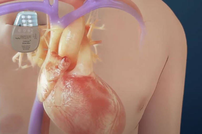 O dispositivo eletrônico, semelhante a um marca-passo convencional, é instalado do lado direito do peito do paciente, sob a pele, e ligado ao coração por dois cabos, passados pelas veias