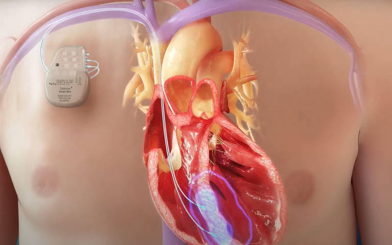 O pulso elétrico, acima de 7,5V,  é acionado em todo batimento cardíaco durante sete horas por dia. Esse tempo é limitado para dar tempo de o coração descansar, aumentando sua efetividade