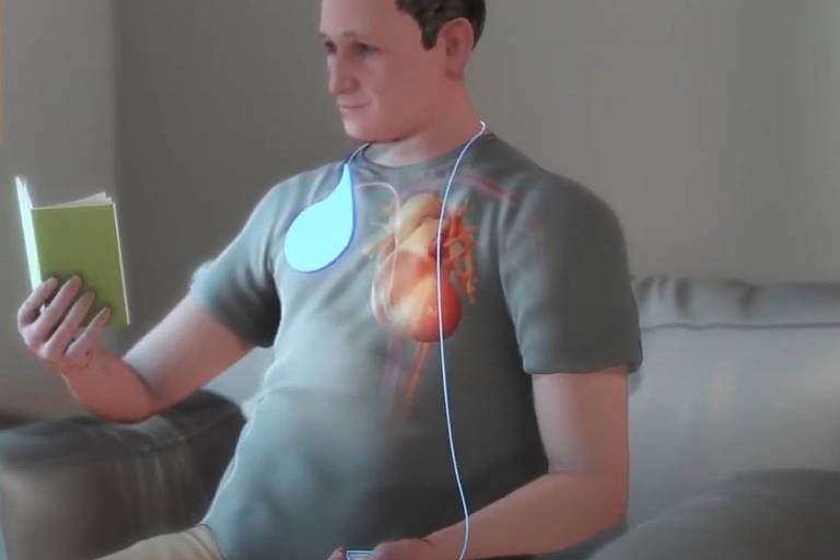 Depois de sete a dez dias, o paciente precisa recarregar a bateria do modulador de contratilidade cardíaca. Para isso, basta colocar uma placa sobre o peito, acima do dispositivo, como uma base de carregamento de celular