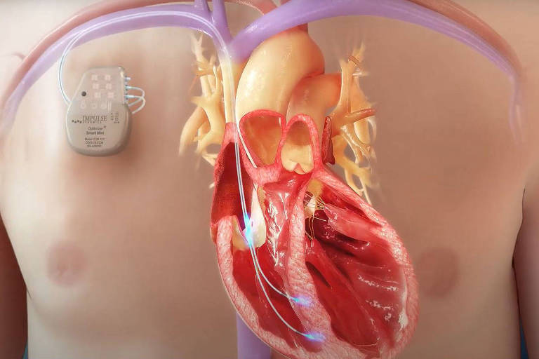 Ilustração de um coração com um dispositivo eletrônico acoplado
