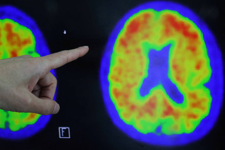 Decisão de agência dos EUA amplia acesso a novo tratamento contra Alzheimer