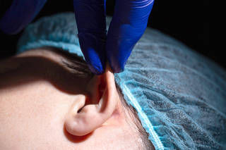A plastic surgeon performs an operation to correct the ears of a female patient. Otoplasty, elimination of protruding ears, plastic surgery. Close-up