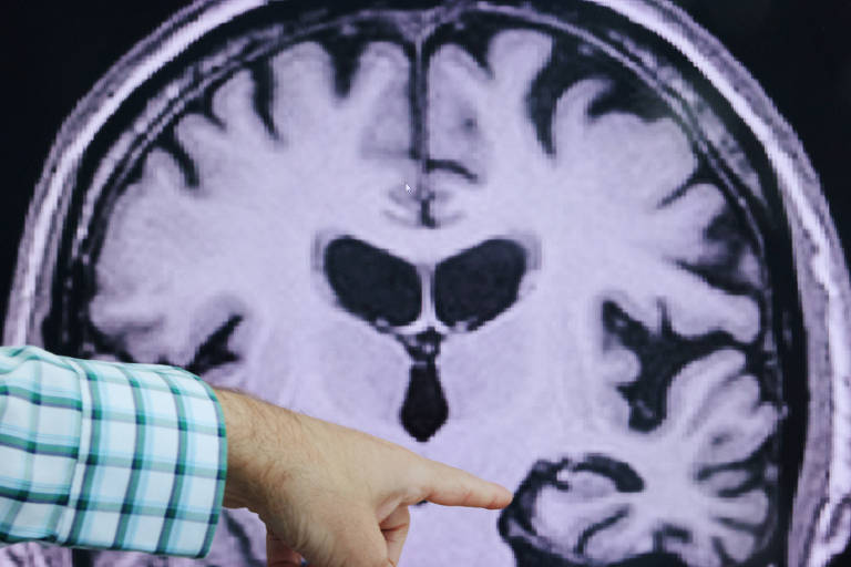 Pessoas negras demoram mais tempo para receber diagnóstico de Alzheimer, aponta estudo