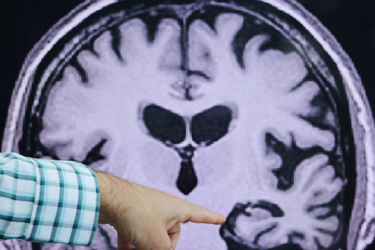 Componente genético ligado ao Alzheimer é descoberto em estudo