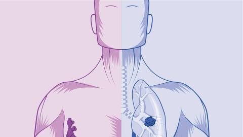 Diagnóstico em estágio inicial é crucial para pacientes com câncer de mama e de pulmão