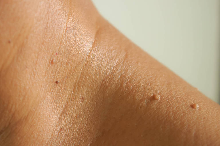 O que são as bolinhas que aparecem na pele conforme envelhecemos?