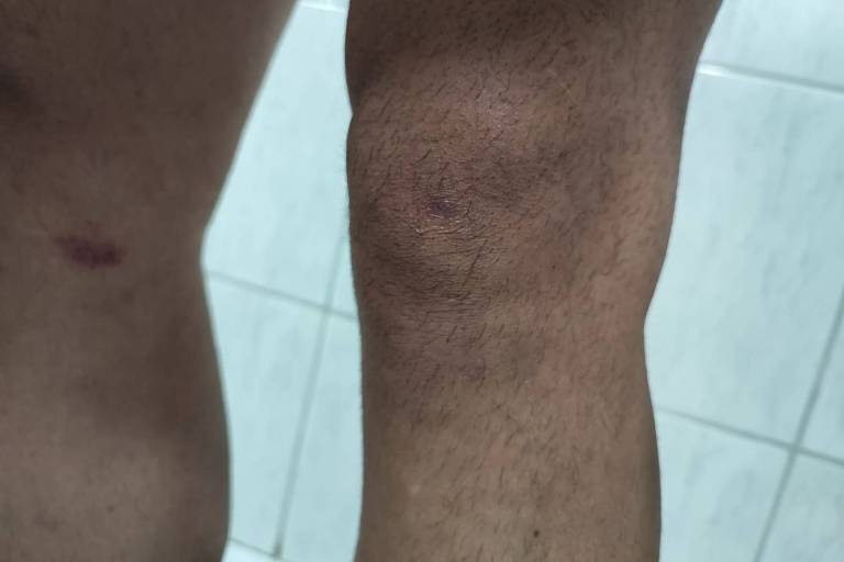 detalhe de marcas de agressão em pernas de homem