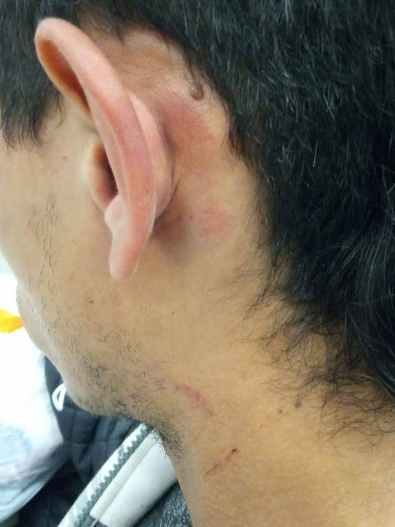 Homem mostra nuca e orelhas machucada por agressões. Ele tem cabelos pretos e está de costas