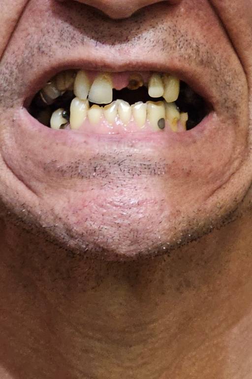 Preso mostra dentes supostamente quebrados por policiais penais durante ação no CE