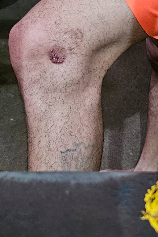 Preso mostra perna supostamente ferida com bala de borracha em unidade prisional do Ceará