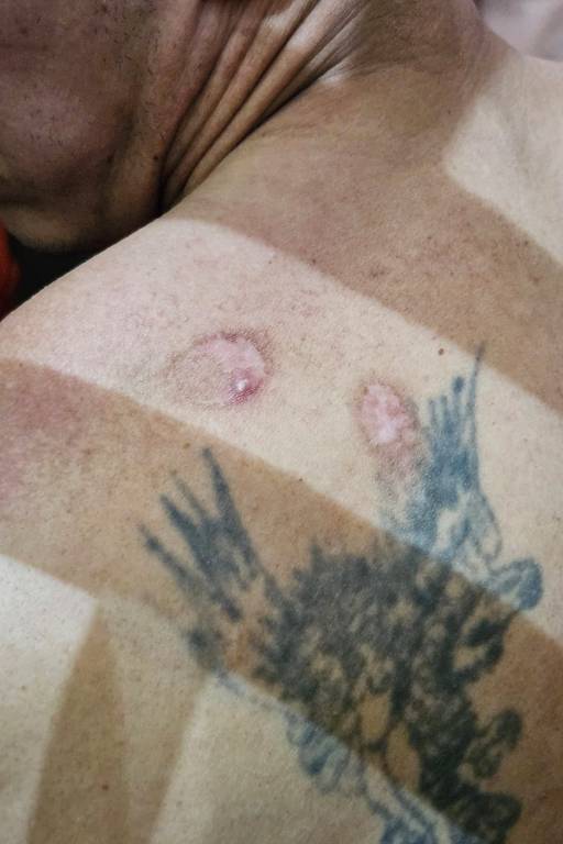 Preso mostra costas supostamente ferida com bala de borracha em unidade prisional do Ceará