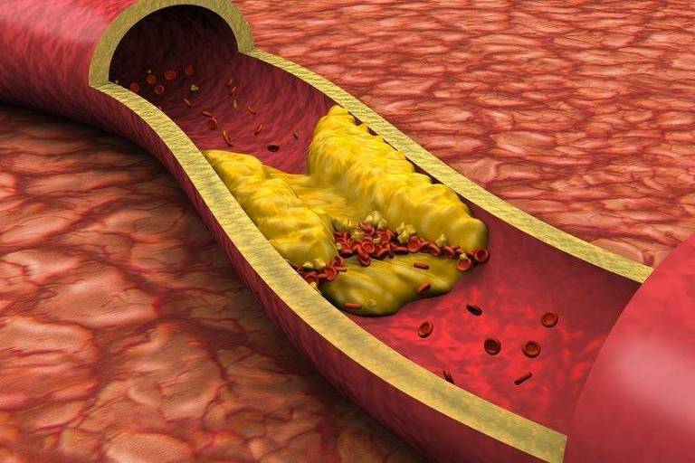 A aterosclerose ocorre quando placas de gordura se desenvolvem nas paredes de nossas artérias