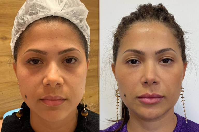Fotos de antes e depois da paciente Sendy Mantovan