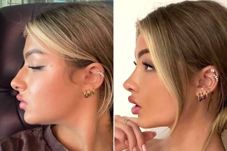 Victoria, que publica no TikTok com o nome de usuário @toriisback, disse que gastou mais de £ 3.500 (R$ 21,7 mil) em uma cirurgia plástica para ter 'nariz de Barbie', segundo reportagem The Sun; na rede social, ele mostrou o antes e depois