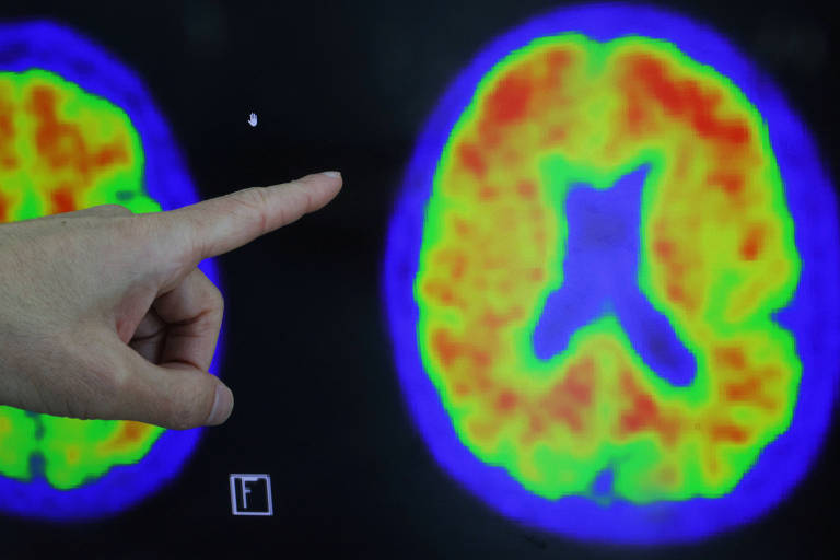 Alzheimer: Remédios que retardam a progressão são nova esperança?