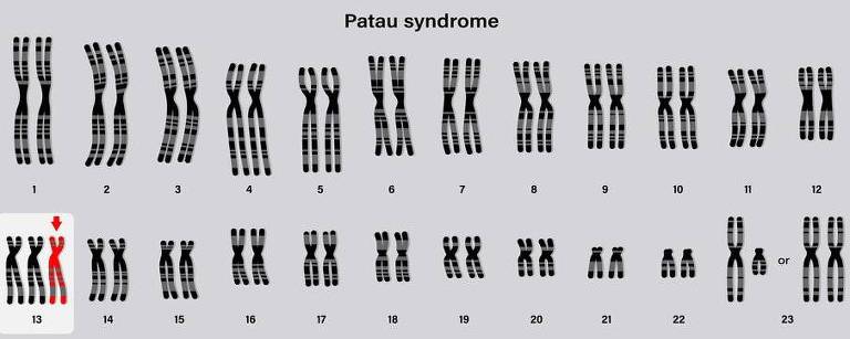 Na síndrome de Patau, há um 13º cromossomo a mais, o que gera uma série de repercussões à saúde

