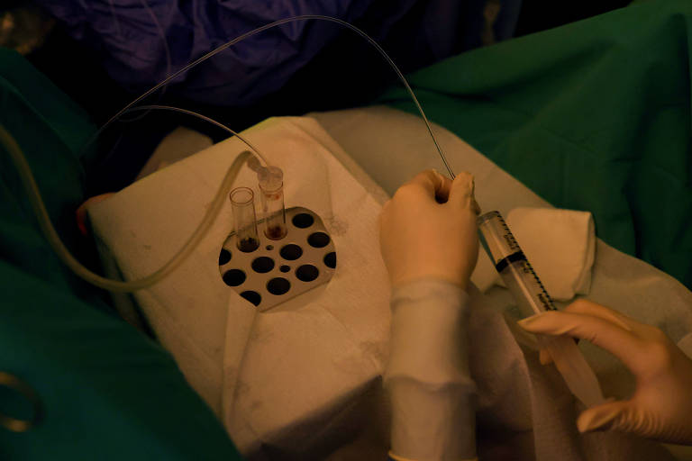 Cirurgia para congelamento de óvulos conta com agulha que aspira folículos no ovário