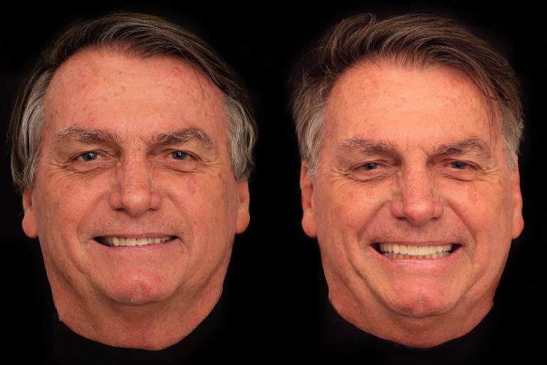 Bolsonaro sorri, antes e depois de procedimento odontológico
