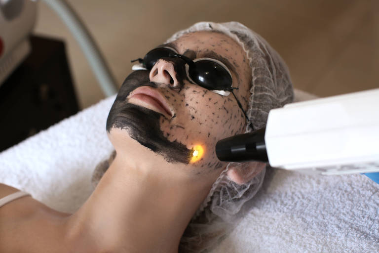 Fotografia mostra uma mulher branca deitada em uma maca com uma touca cirúrgica protegendo os cabelos e óculos metálicos protegendo os olhos; sobre o seu rosto há uma camada de um produto preto, que vai sendo retirado com a ponteira do laser apontado para seu rosto