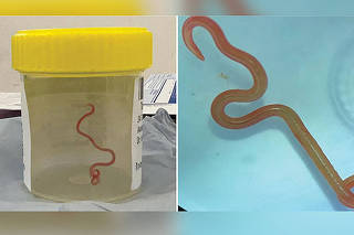 Combination photo of roundworm found in Australian woman?s brain