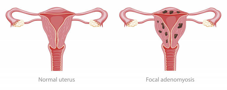 Ilustração compara um útero normal (lado esquerdo) com um útero com adenomiose (lado direito)