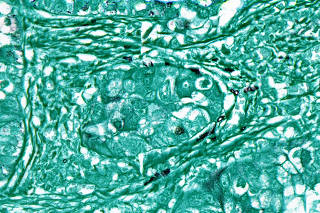 a section of a human lung tumor, in turquoise, with fungi stained in black. (Lian Narunsky Haziza and Nancy Gavert via The New York Times)