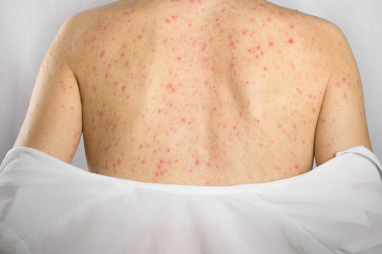 Foto conceitual de uma mulher de costas, apresentando manchas vermelhas na pele. Enfermidade. 