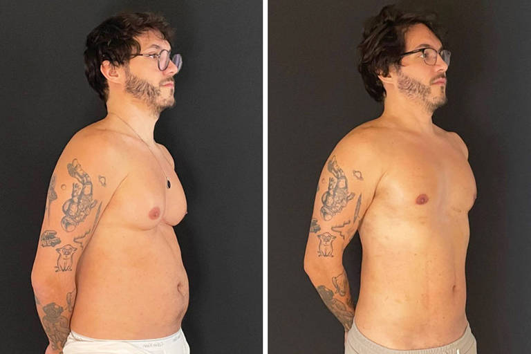 Eliezer mostra resultado de cirurgia para redução de mamas e lipoaspiração: 'Diferença gritante'