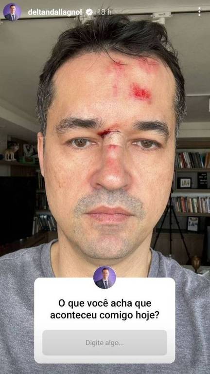 O ex-deputado Deltan Dallagnol publica foto com rosto machucado
