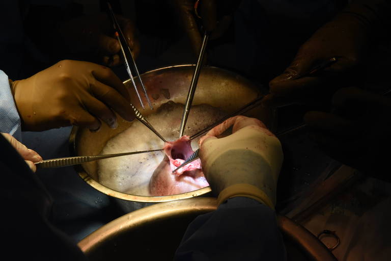 Objetos cirúrgicos, segurados por pessoas; seguram uma parte de um órgão aberto; há um foco de luz sobre o órgão