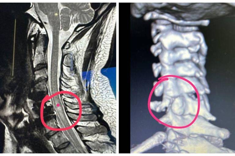 Radiografias mostram lesões na coluna
