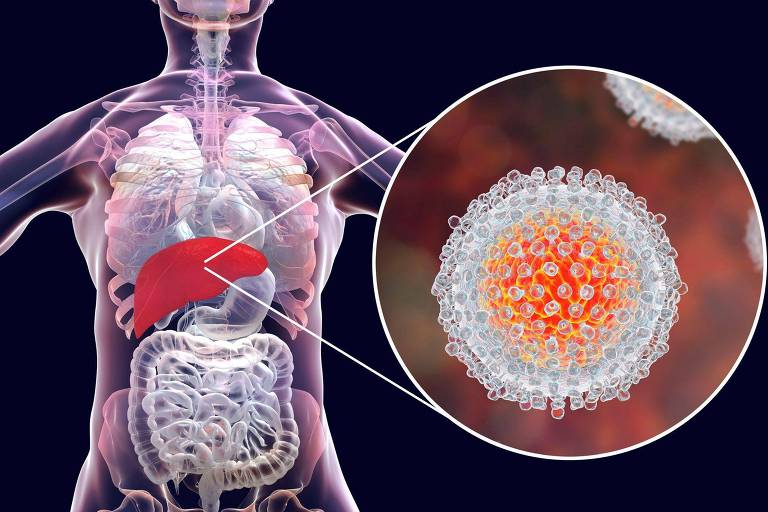 Infecção por hepatite C: Ilustração mostra o fígado e uma visão aproximada dos vírus da hepatite C
