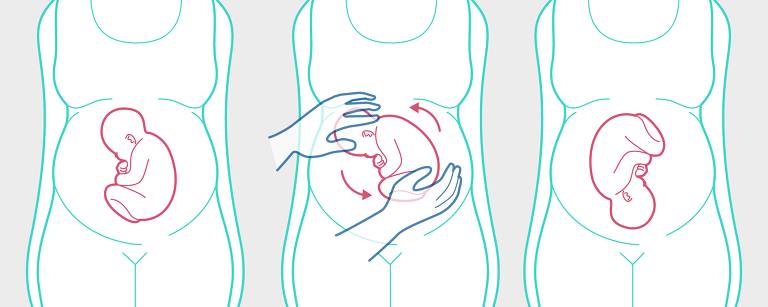 ilustração girando o feto dentro da barriga