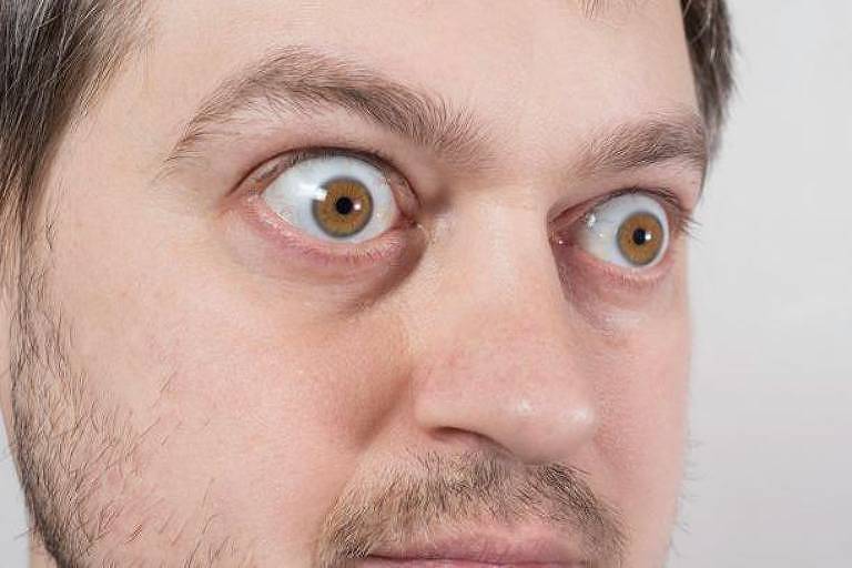 Homem com olhos saltados pela doença ocular da tireoide