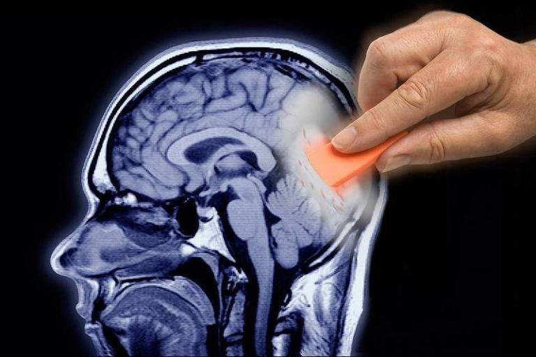 Imagem de exame do cérebro com pessoa segurando uma borracha
