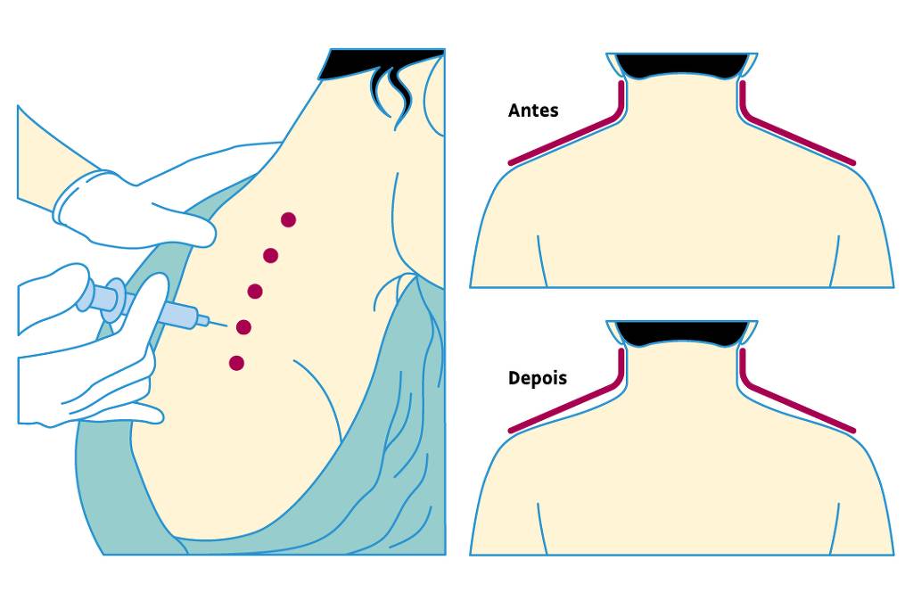 Botox is applied to the trapezius to imitate Barbie’s long, thin neck