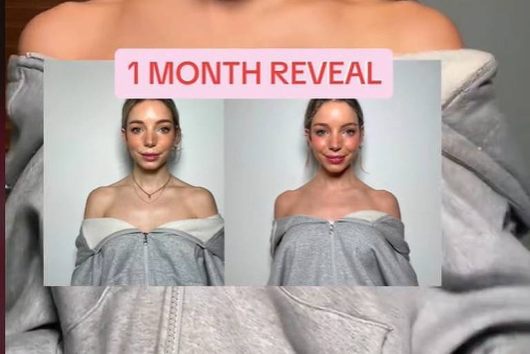 Fotos de antes e depois mostram influenciadora com ombros mais relaxados após uso do Botox na região