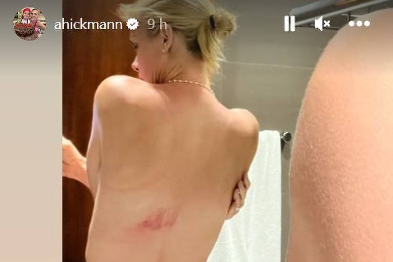 Em foto colorida, mulher faz selfie de costas para o espelho e mostra a lesão na altura das costelas