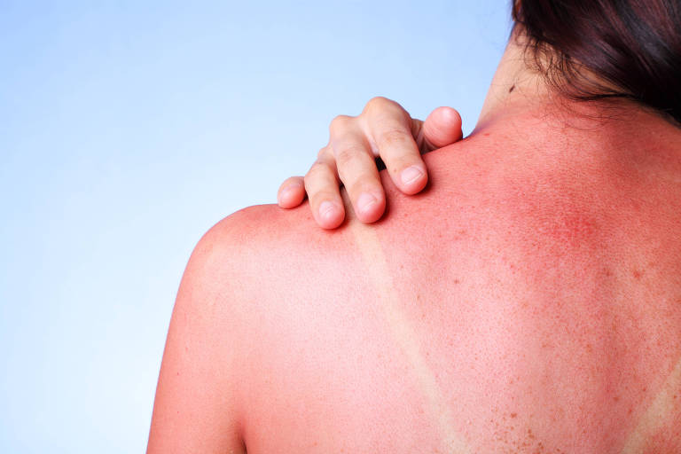 Hidratação e limpeza ajudam a tratar pele com queimaduras de sol; veja dicas