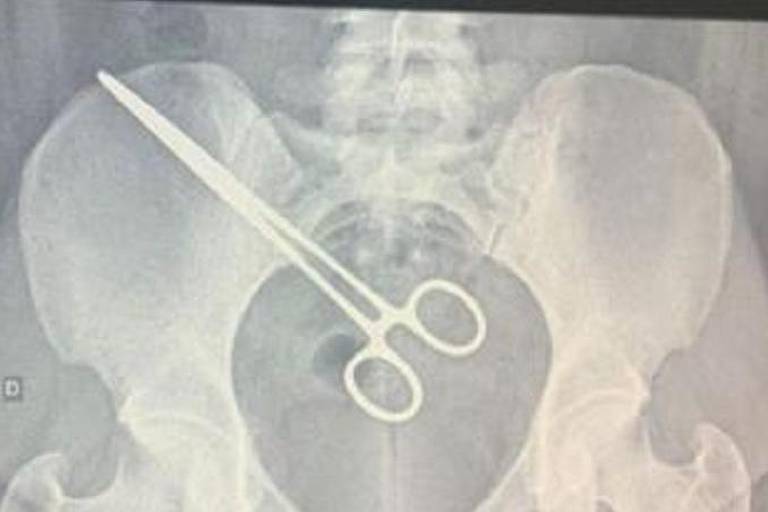 foto de um raio x de uma pinça cirúrgica na altura de um quadril