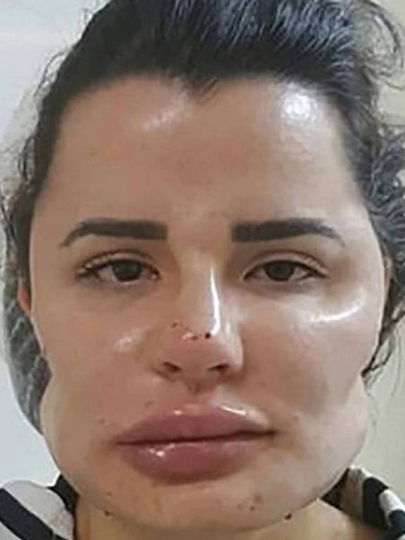 rosto de mulher deformado com cirurgia
