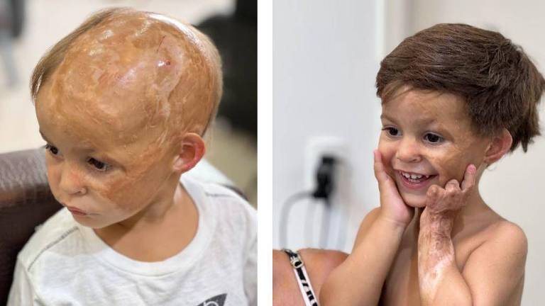 Lorenzo, 2, antes e depois de receber a prótese capilar
