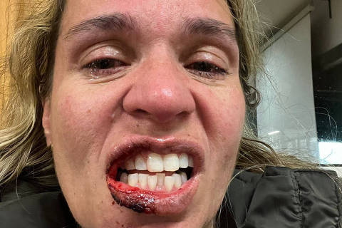 A estudante brasileira Grazielle Tavares, 49, mostra marcas de agressões sofridas dentro da Universidade do Minho, em Braga, no Norte de Portugal. A jornalista carioca foi agredida por um colega de classe português, que também insinuou que ela pagava o curso se prostituindo 
( Foto: Arquivo pessoal ) DIREITOS RESERVADOS. NÃO PUBLICAR SEM AUTORIZAÇÃO DO DETENTOR DOS DIREITOS AUTORAIS E DE IMAGEM