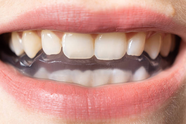 Fotografia colorida foca a boca de uma mulher branca que está usando uma placa de acrílico transparente