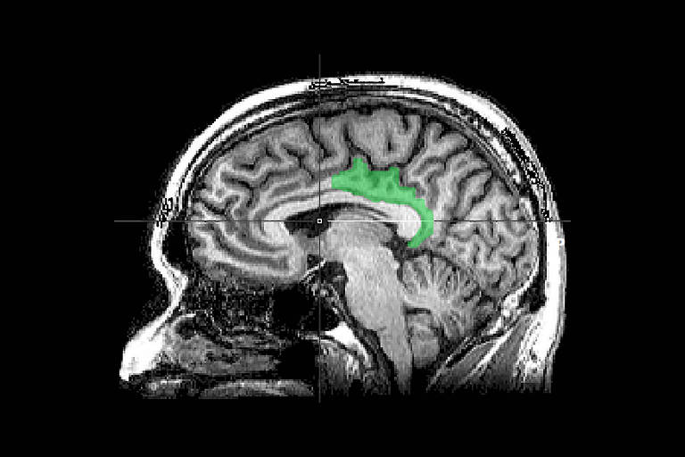 Imagem em preto e branco de uma ressonância magnética destaca o córtex cingulado posterior em verde