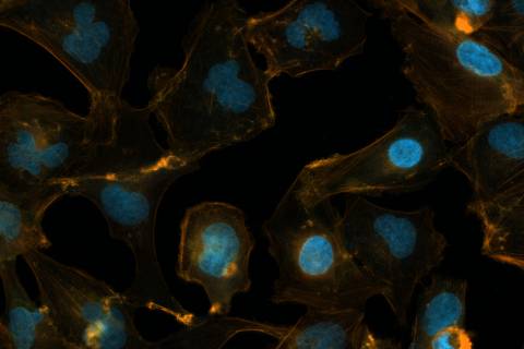 Células de meduloblastoma mantidas em cultura 3D (esferoide tumoral) ou 2D no laboratório do grupo de pesquisa 