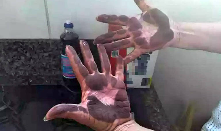 A foto mostra mãos sujas do "pó preto" da Usiminas em Ipatinga.