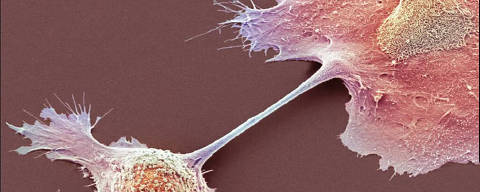 Uma micrografia eletrônica de varredura colorida de células cancerígenas no pâncreas