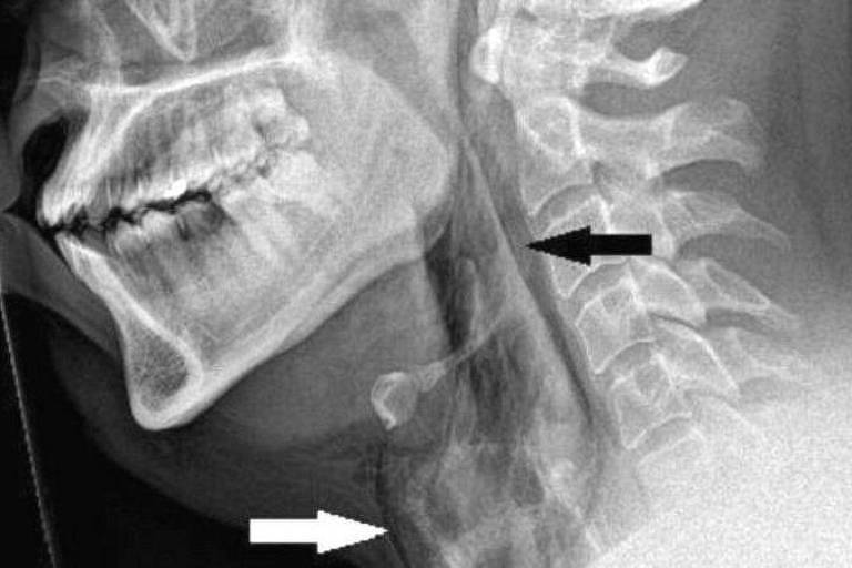 Radiografia mostra garganta perfurada por espirro